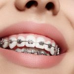 orthodontist in east los angeles